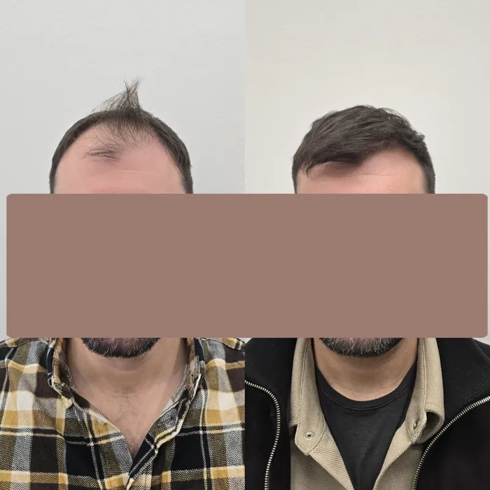 Αποτέλεσμα μεταμόσχευσης μαλλιών - περιστατικό